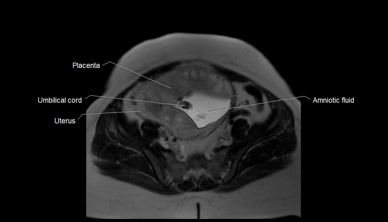MRI fetal anatomy axial image 29.webp